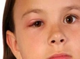 Çocuklarda Göz Şişmesi Belirtileri ve Tedavisi