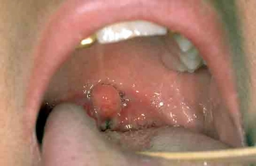 Boğaz Şişmesi Belirtileri ve Tedavisi